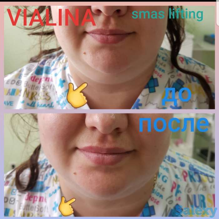 Смас лифтинг, фотография 11