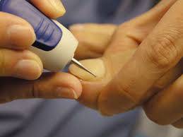 коррекция вросших ногтей,аппаратный педикюр.наращивание ногтей, фотография 1