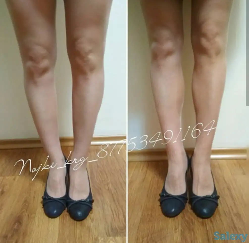 Силиконовые накладки для кривых ног, фотография 9