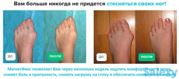 Магнитная вальгусная шина MagnetFix бандаж, фотография 3