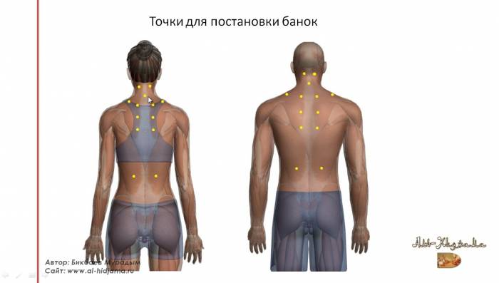 Кровопускание Хиджама , фотография 2