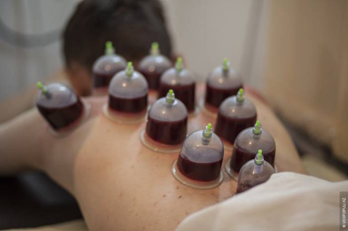 Хиджама кровоспускание, фотография 1