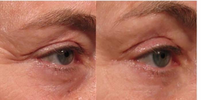 Подтяжка лица без операции, фотография 1