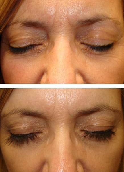 Средство для роста ресниц и бровей Lurey Lash Md, фотография 6