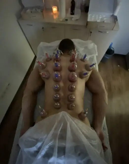 Хиджама в Астане. Услуги хиджамы, фотография 3