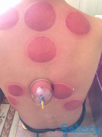 Хиджама не дорого, сертифицированный специалист, стаж 5 лет, окуратно, фотография 1