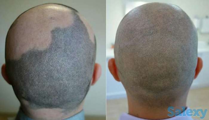 Трихопигментация в Казахстане, фотография 1