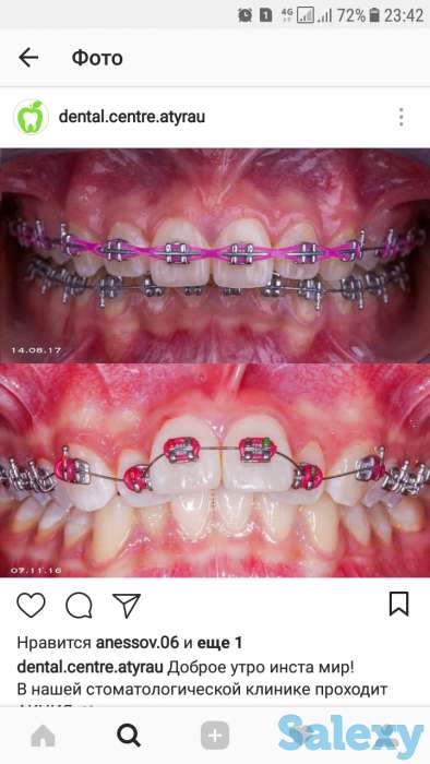 Брекеты недорого, фотография 1