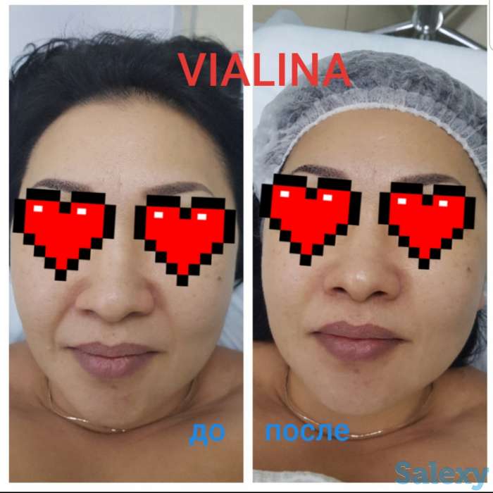 Смас лифтинг, фотография 10