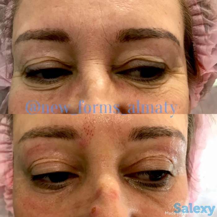 Аппаратная косметология для лица и тела, фотография 5