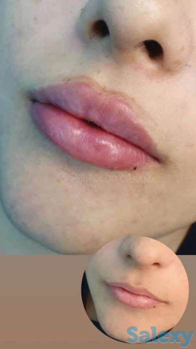 Косметолог Увеличение губ, фотография 5