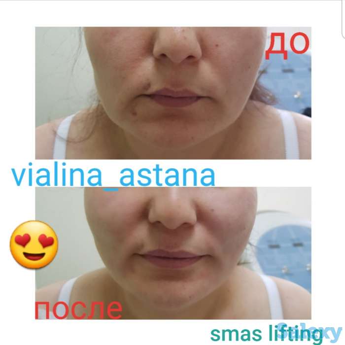 Смас лифтинг, фотография 7