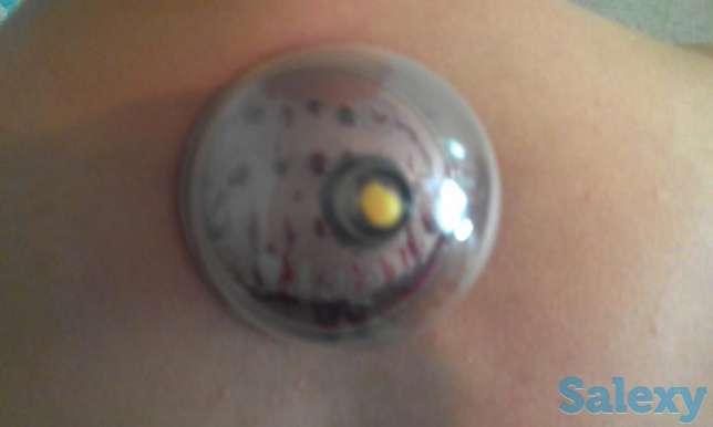 Хиджама - оздоровительное кровопускание, вам понравится, на выезд, фотография 1