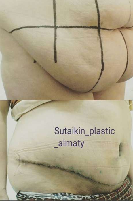 Абдоминопластика в Алматы , фотография 1