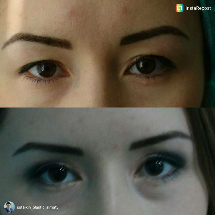 Блефаропластика в Алматы, фотография 2