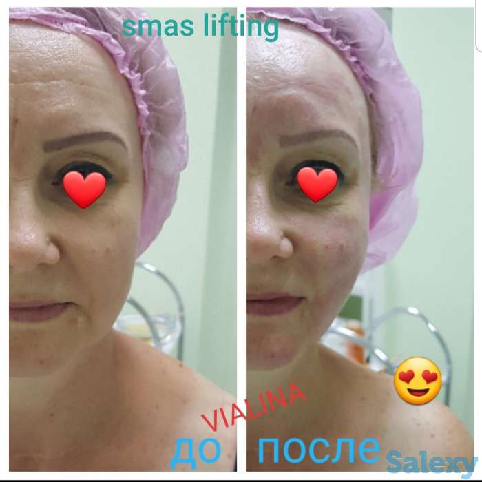 Смас лифтинг, фотография 8