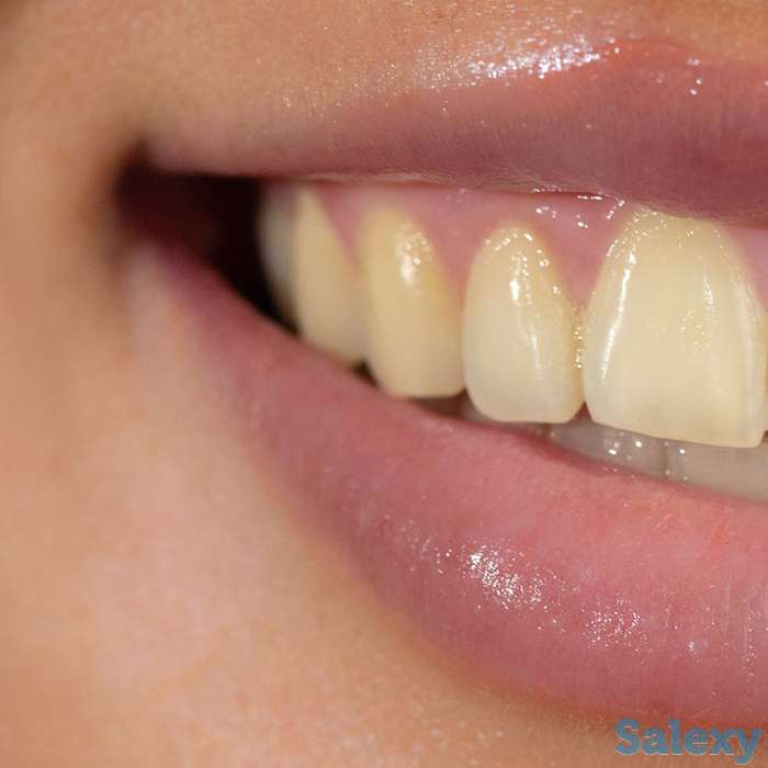 Отбеливание для зубов Happy Smile, фотография 8