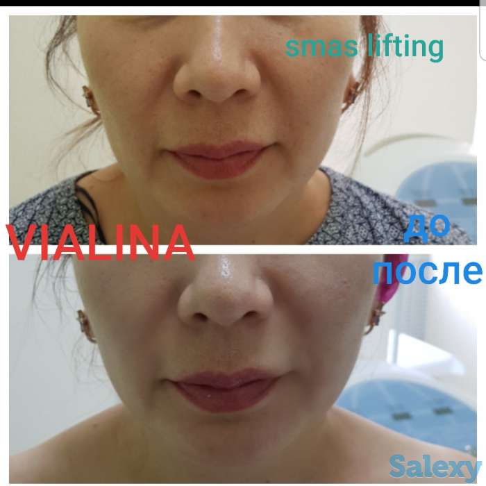 Смас лифтинг, фотография 12