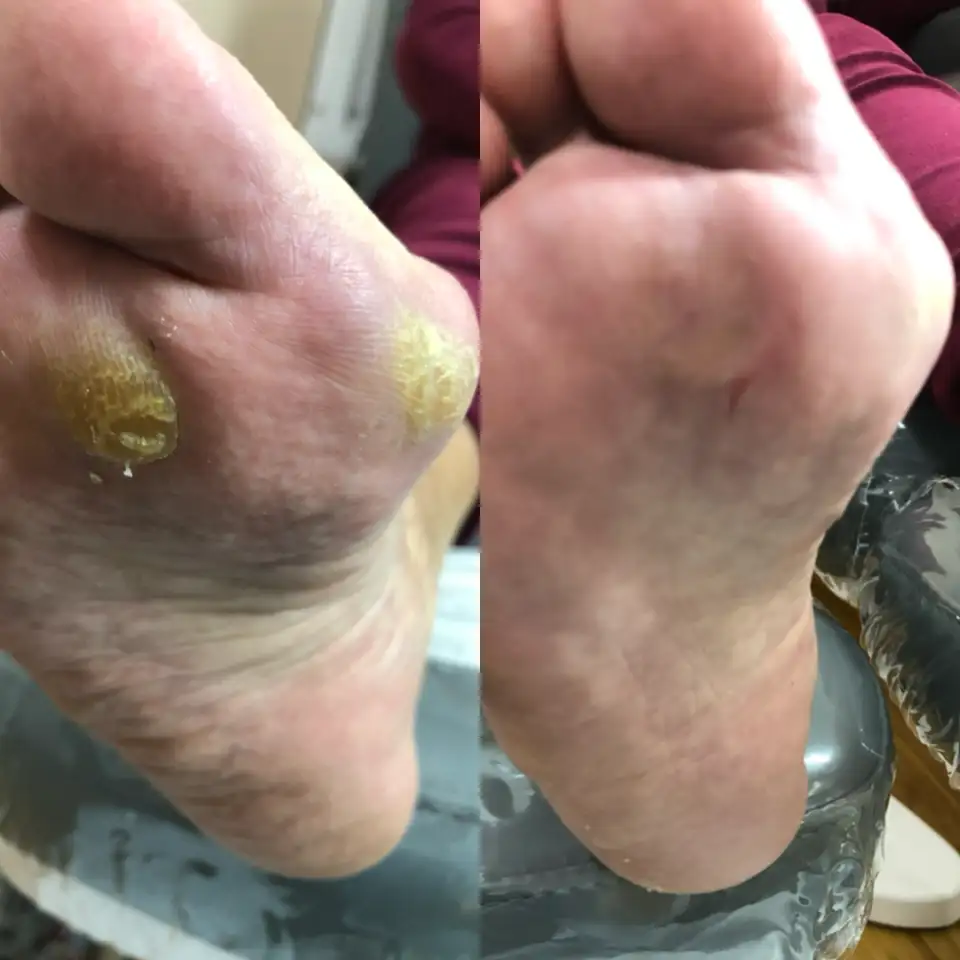 Педикюр Kart, медицинский, фотография 3