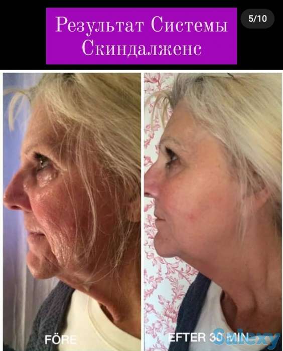30минутная нехирургическая подтяжка лица Скиндалженс, фотография 5