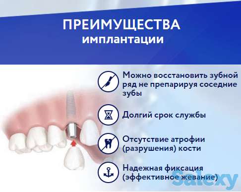 Имплантация зубов, фотография 1