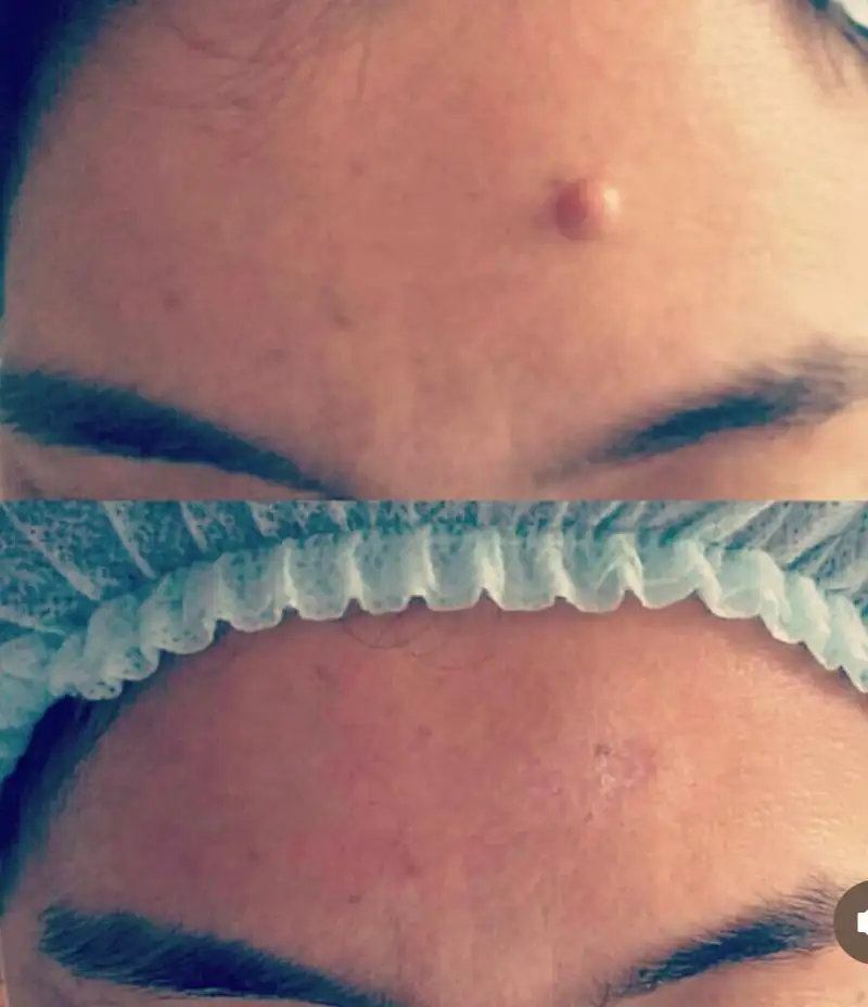 Лазерное удаление бородавок, родинок., фотография 2