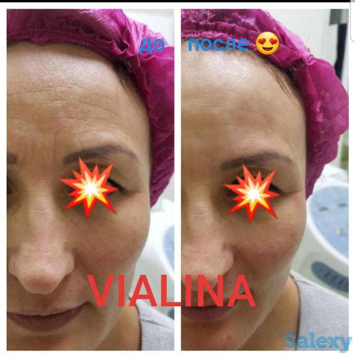 Смас лифтинг, фотография 2