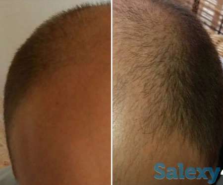 Аппарат для восстановления и роста волос BYAS Hair Completer немецкой компании WellStar BYAS, фотография 3