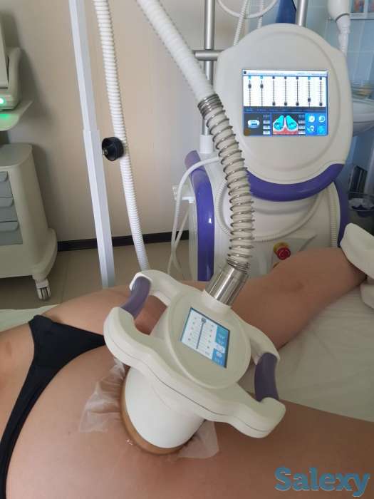 Криолиполиз, фотография 3