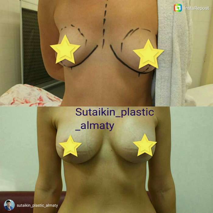 Увеличение груди в Алматы, фотография 4