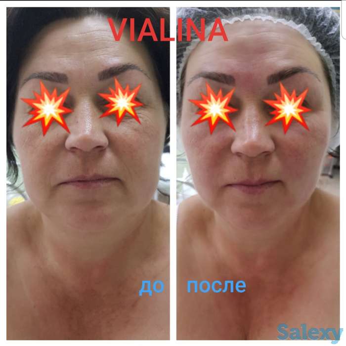 Смас лифтинг, фотография 3