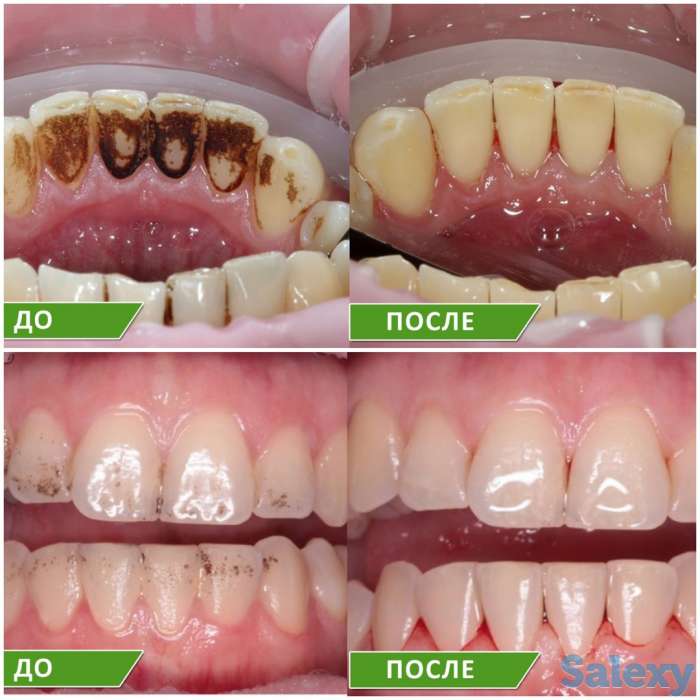 Профессиональная чистка зубов!!!!!Лучшая цена!!!!!Акция!!!!!, фотография 1