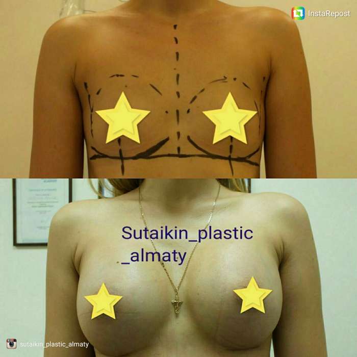 Увеличение груди в Алматы, фотография 5