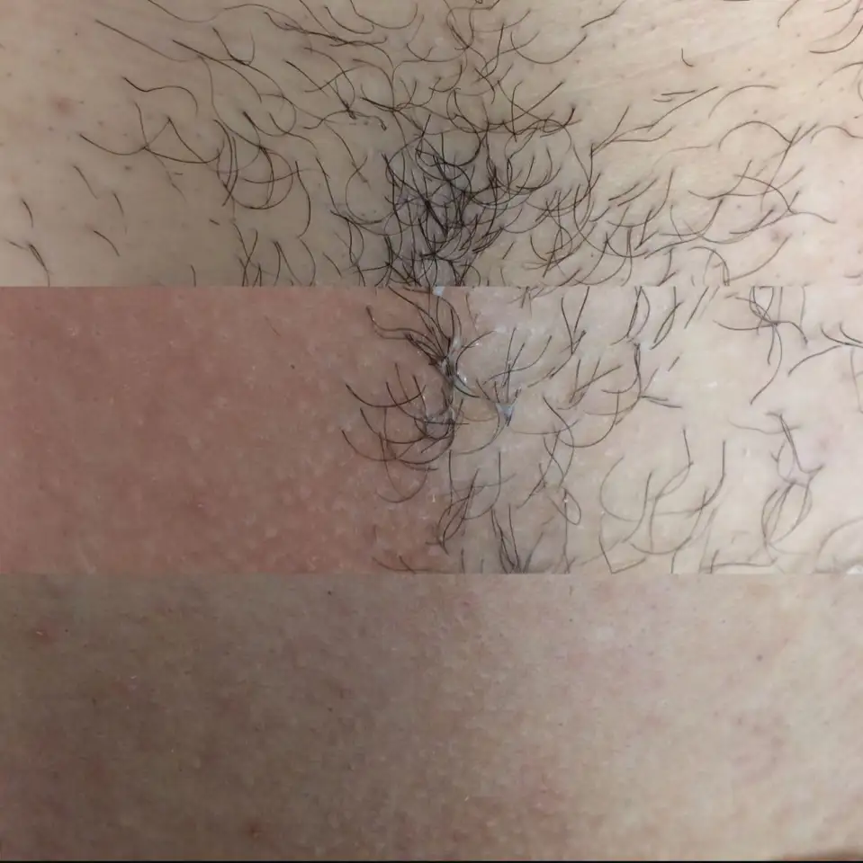 Шугаринг, фотография 3